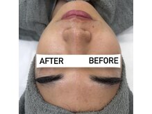 クレア(Claire)/ホワイトニングピーリング1回