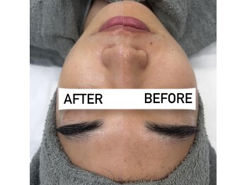 クレア(Claire)/ホワイトニングピーリング1回