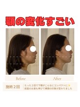 ミラクル(Miracle)/下顎の変化がすごい！！