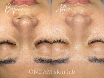 オンダム 南青山 表参道(ONDAM)/【皮脂・毛穴開き】