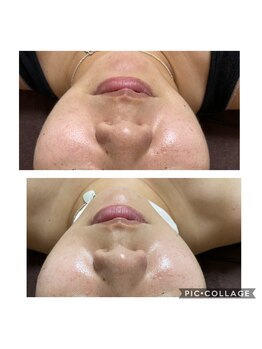 シャルム(CHARME)/ハーブフェイシャル☆