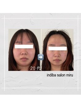 ミル(miru)/インディバフェイシャル