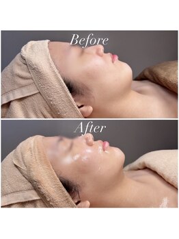 アンシャンテ(ENCHANTER)/小顔フェイシャル