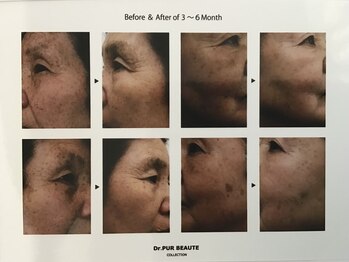 ピュール(pure)/純粋レチノールピールの効果