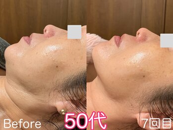 ハレオラ(HaleOla)/50代★もはや別人！？素晴らしい