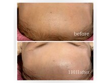 シュガーリングハウス ベル(Bell)の雰囲気(1度でこの変化!内側から艶発光低刺激ピーリング【ララピール】)