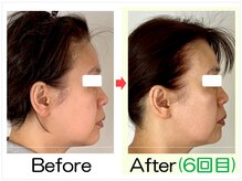 小顔矯正エステ プリュムレーヴ/50代｜横顔のもたつき改善