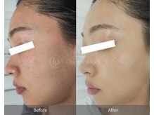 プライベートエステティックサロン アメジスト(AMETHYST)/ダクトピール症例写真４