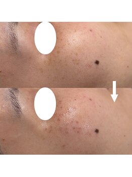 コリー(Kolly)/シミに反応！