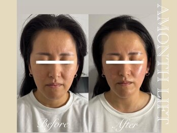 ミリュール(Millule)/アマンス4回目