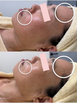 クレア(Claire)/乳酸菌ピール1回のみ