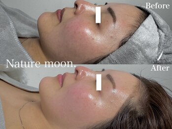 ナチュールムーン(Nature moon.)/ハーブピーリング