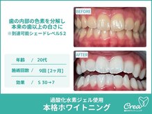 クレア(Crea)/【ホワイトニング症例写真】