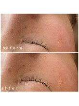 メナードフェイシャルサロン 岐阜茜部/毛穴ケア引き締め&うるおい補給