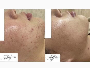 ビズビズ 天王寺店(bisebise)/〈症例〉ニキビケア・跡・赤み