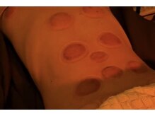 デルタエヌピー63+(δnp63+)/カッピング【小顔/薬院/福岡】