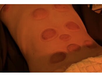 デルタエヌピー63+(δnp63+)/カッピング【小顔/薬院/福岡】