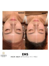 アクシア ビューティー サロン(AXSIA)/【EMS】BeforeAfter