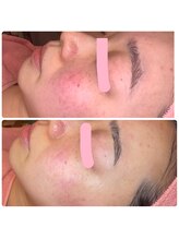 ヒメミ(Himemi)/バリア機能強化粧品2週間ご使用