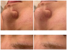 メゾンリュバン 梅田店(Maison Ruban)/毛穴洗浄・美白フォト|毛穴ケア