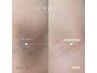 【ルメラ】黒ずみケア/脇、ヒップ　モニター1箇所99,000→77,000