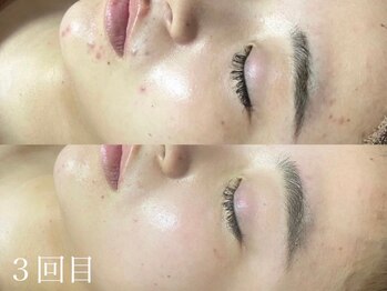 ホワイトアクア 天王寺本店(WHITE AQUA)/ハーブピーリング/毛穴/天王寺