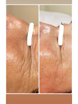 ピュアリ(Purely) /メソスキンカラー