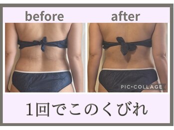 ヨサパーク コクリ(YOSA PARK kokuRi)/1回で激変!速攻くびれ