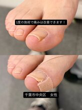 巻き爪じゅん 千葉駅前店/長年の巻き爪の痛みが1回で軽減