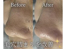 ブリリオプラス 四条烏丸店(Brillio plus)/部分ハイドロフェイシャル