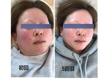 アジサイ(Ajisai)/光フォトで赤ら顔のお悩み改善