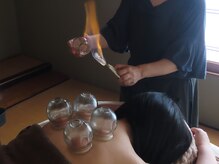 鍼灸ゆくゆくの雰囲気（吸い玉（カッピング）もご用意しております♪）