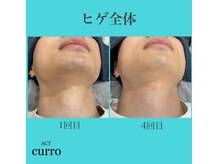 アクト クロ(ACT curro)/【ヒゲ全体】脱毛施術例