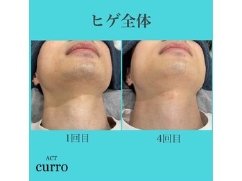 アクト クロ(ACT curro)/【ヒゲ全体】脱毛施術例
