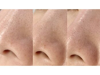 リリー 吉祥寺(Rillie)/‥ハイドラフェイシャル‥