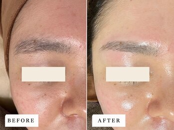 ビビ(BiBi)/顔脱毛でくすみオフトーンアップ