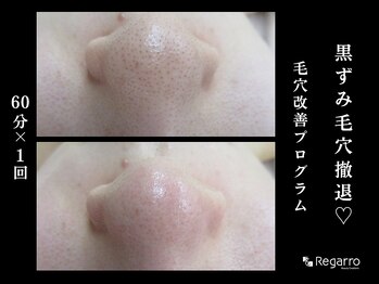 レガロビューティクリエイションズ桜川店/脱・黒ずみ！毛穴改善プログラム