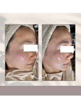 サクラサク(SAKULASAKU)/ビフォーアフター