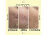 大人気☆【毛穴/小顔/シミ】細胞復活エクソソーム導入¥35200→初回¥17600