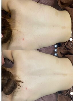 フルール(Fleur)/■背中トリートメント■