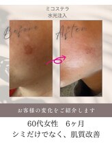 レガート(Legato)/シミケア水光注入で！