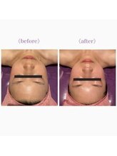 ライゼ(REISE)/コルギの美肌効果(小顔/くすみ)