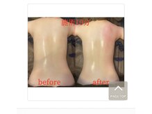 ランベリー 新宿店(Lembellir)/ハイパーナイフEX2強圧リンパ