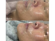 アピール(Appeal)/お客様BeforeAfter-ヒゲ脱毛-