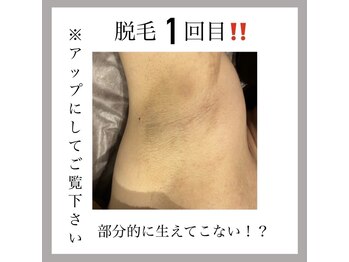 オークツリー(oak tree)/魅せるワキ脱毛