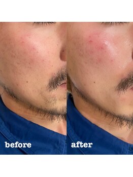 リリー(Lily)/メンズフェイスワックス