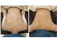 サロンドフェイス 木曽川店(Salon de Faith)/お背中のおいろみ改善♪