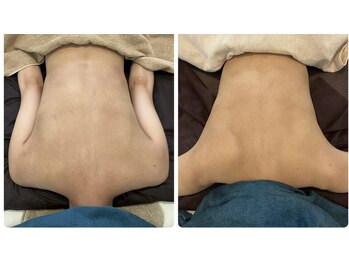 サロンドフェイス 木曽川店(Salon de Faith)/お背中のおいろみ改善♪