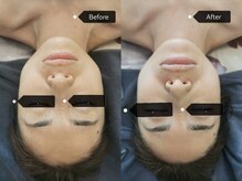 シークレット(Secret)/小顔＋美白