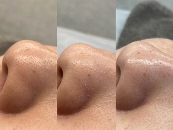 リリー 吉祥寺(Rillie)/‥ハイドラフェイシャル‥